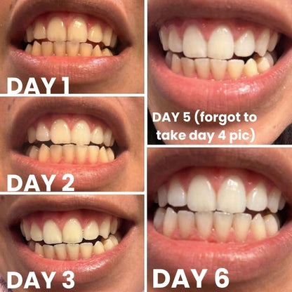 Teeth Whitening Strips Kit | PortableDental Whitening Strips | ReducedSensitivity White Strips for Home Use