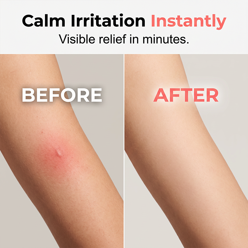 ✨Limited-time 50% off ✨Portable mosquito bite relief pen